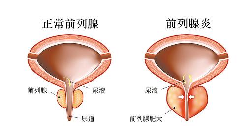 關(guān)于前列腺與性功能的關(guān)系，探究?jī)烧咧g的關(guān)聯(lián)與影響，前列腺與性功能關(guān)系探究，關(guān)聯(lián)與影響分析