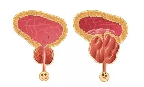 老公的前列腺增大挑戰(zhàn)，理解、支持與共同對抗，老公前列腺增大，理解、支持與共同應對的挑戰(zhàn)