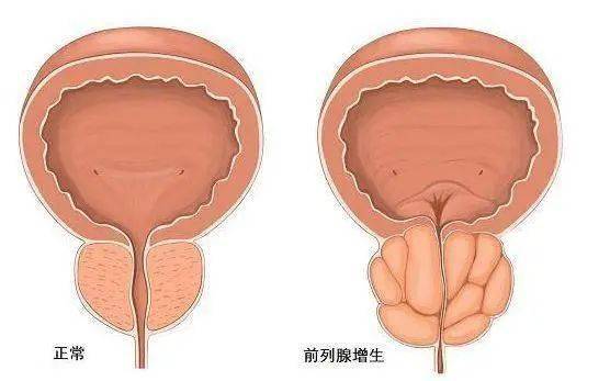 前列腺鈣化，一種常見(jiàn)的前列腺疾病及其相關(guān)知識(shí)解析，前列腺鈣化解析，常見(jiàn)疾病與相關(guān)知識(shí)探討