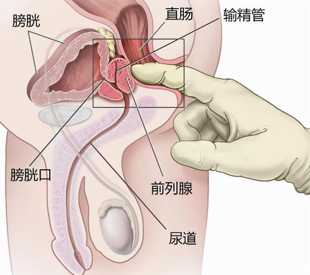 前列腺炎，重新認(rèn)識(shí)男性健康的誤區(qū)，重新認(rèn)識(shí)男性健康誤區(qū)，前列腺炎解析