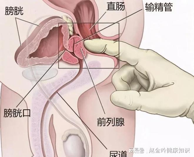 慢性前列腺炎，能否徹底治愈？解析與探討，慢性前列腺炎的治愈可能性解析與探討