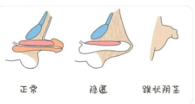 關(guān)于做包皮手術(shù)的費用分析，包皮手術(shù)費用詳解