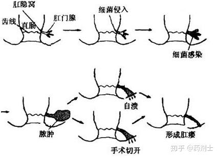 關(guān)于我才17歲陽瘺會(huì)自己恢復(fù)嗎的一些探討，關(guān)于17歲陽瘺是否會(huì)自行恢復(fù)的探討