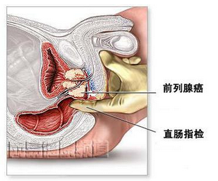 根治前列腺疾病的最佳中藥偏方，探尋古老智慧的新希望，古老智慧新希望，最佳中藥偏方根治前列腺疾病