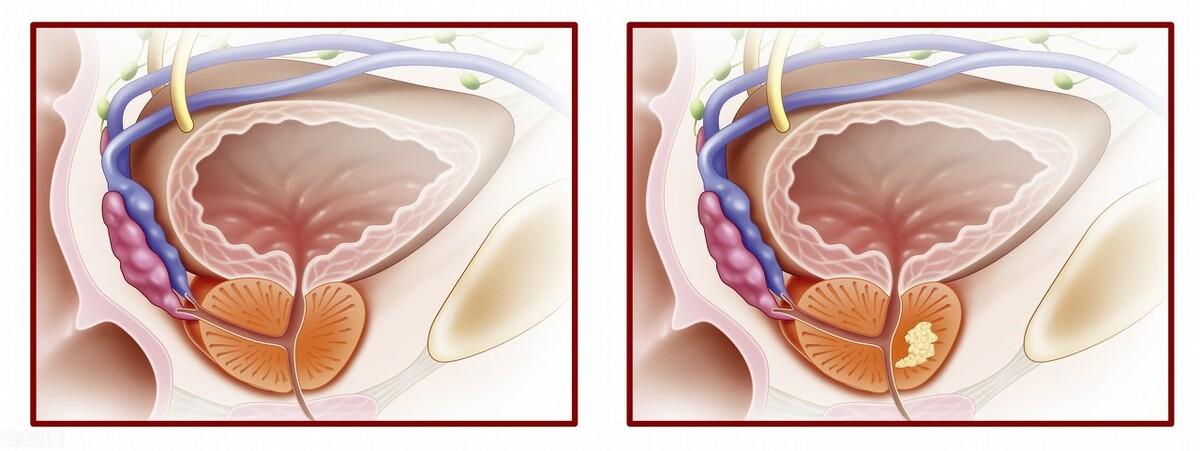 前列腺鈣化，揭示其潛在危害，前列腺鈣化，潛在危害揭秘