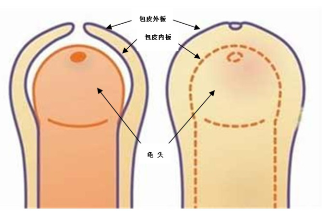 包莖及其相關(guān)圖片，了解、識(shí)別與處理，包莖詳解，圖片、識(shí)別、處理方法全攻略