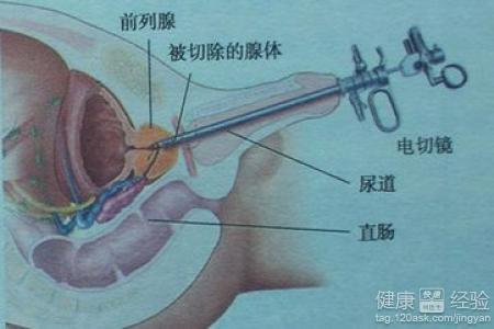 如何控制前列腺增生，如何控制前列腺增生的發(fā)展及癥狀？