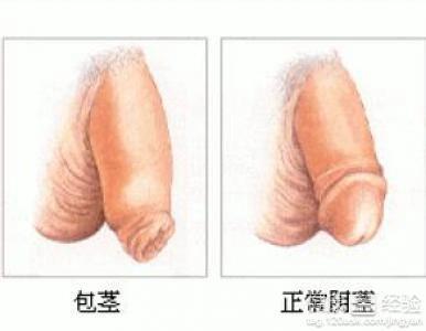 包莖過長對(duì)身體的影響及應(yīng)對(duì)措施，包莖過長對(duì)身體的影響與應(yīng)對(duì)措施解析